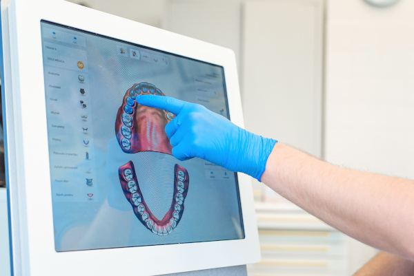 Imagerie 3D produite par un scanner intra oral