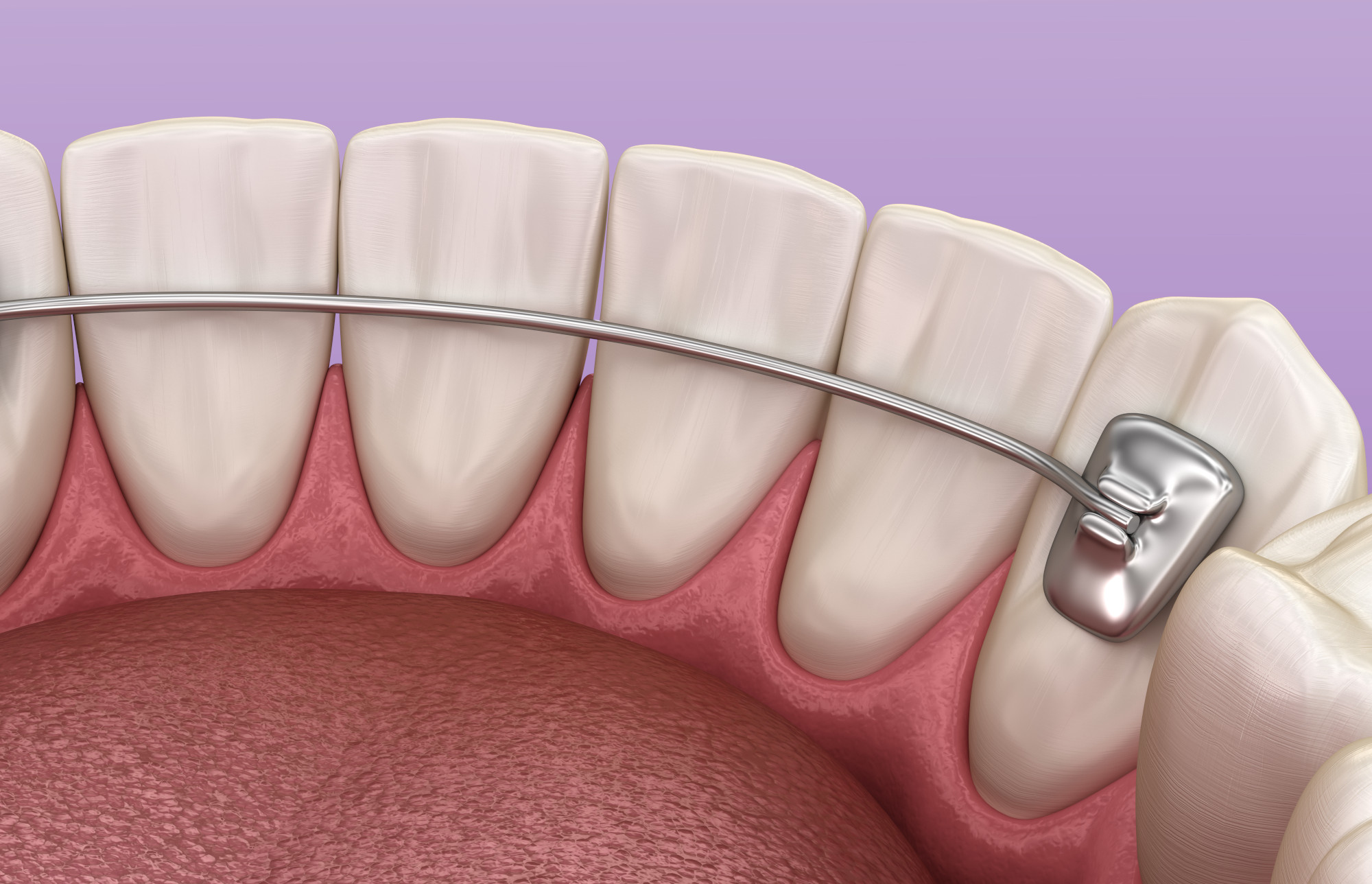 Fil de contention collé sur la face interne des dents