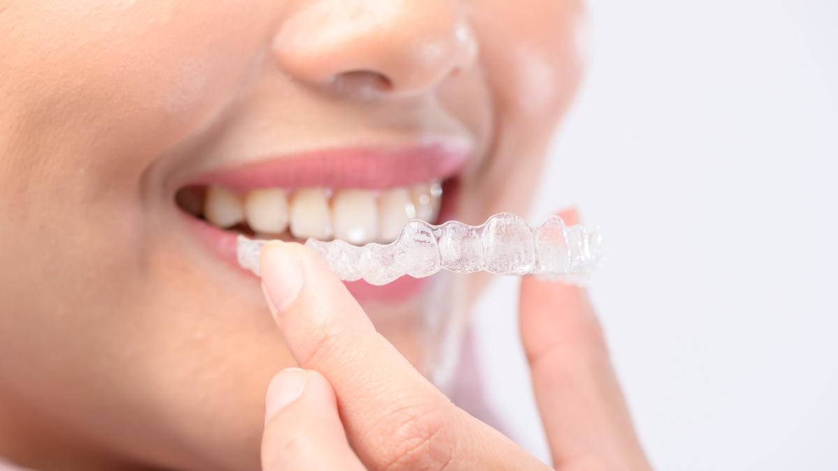 Aligneurs transparents pour la correction de la supraclusion