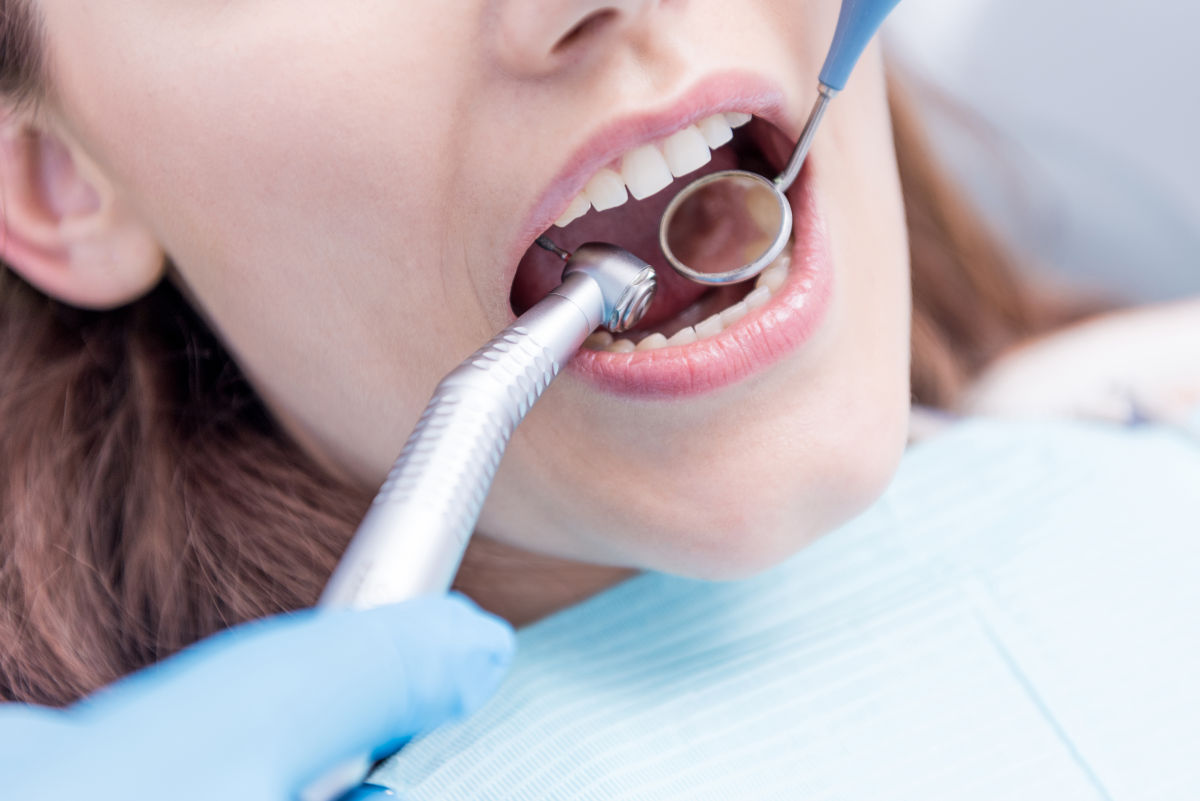 Stripping dentaire : l'orthodontiste réduit finement l'émail entre deux dents