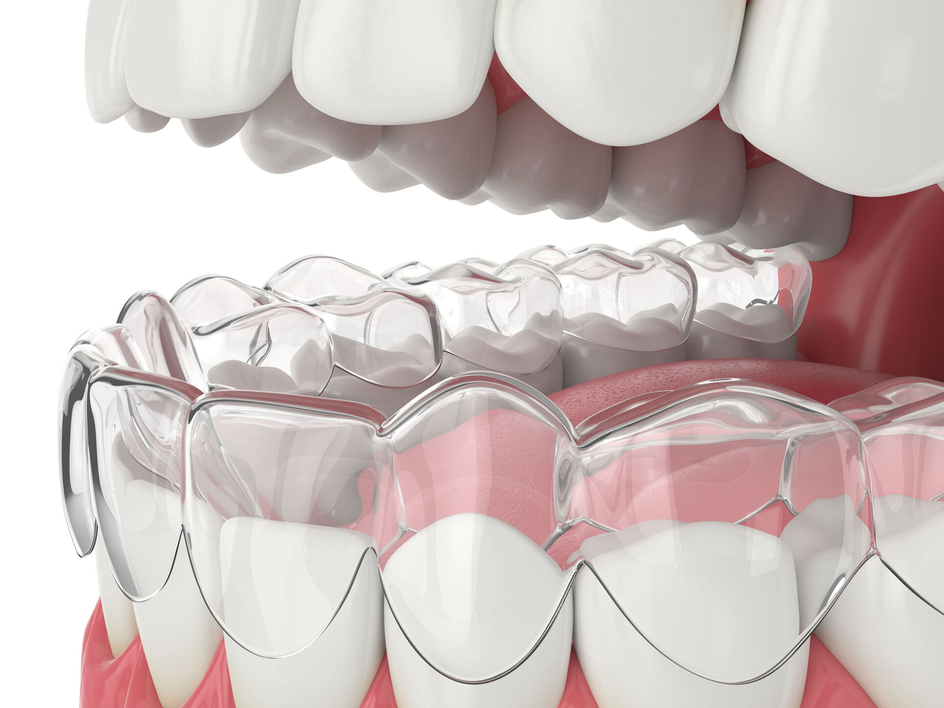 Taquet dentaire : aligneur Invisalign en place sur l'arcade