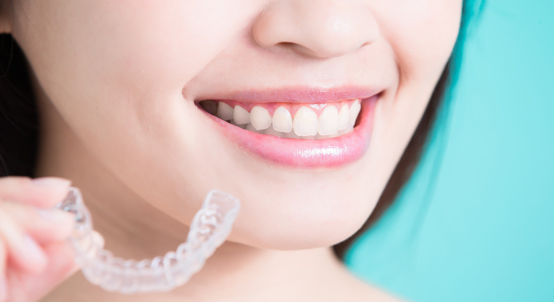 Sourire et gouttière Invisalign : les taquets guident le mouvement