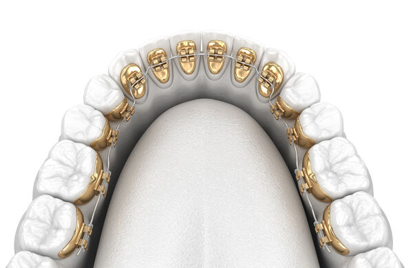 orthodontie linguale