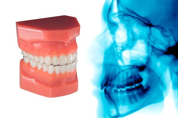 Radiographie et Invisalign