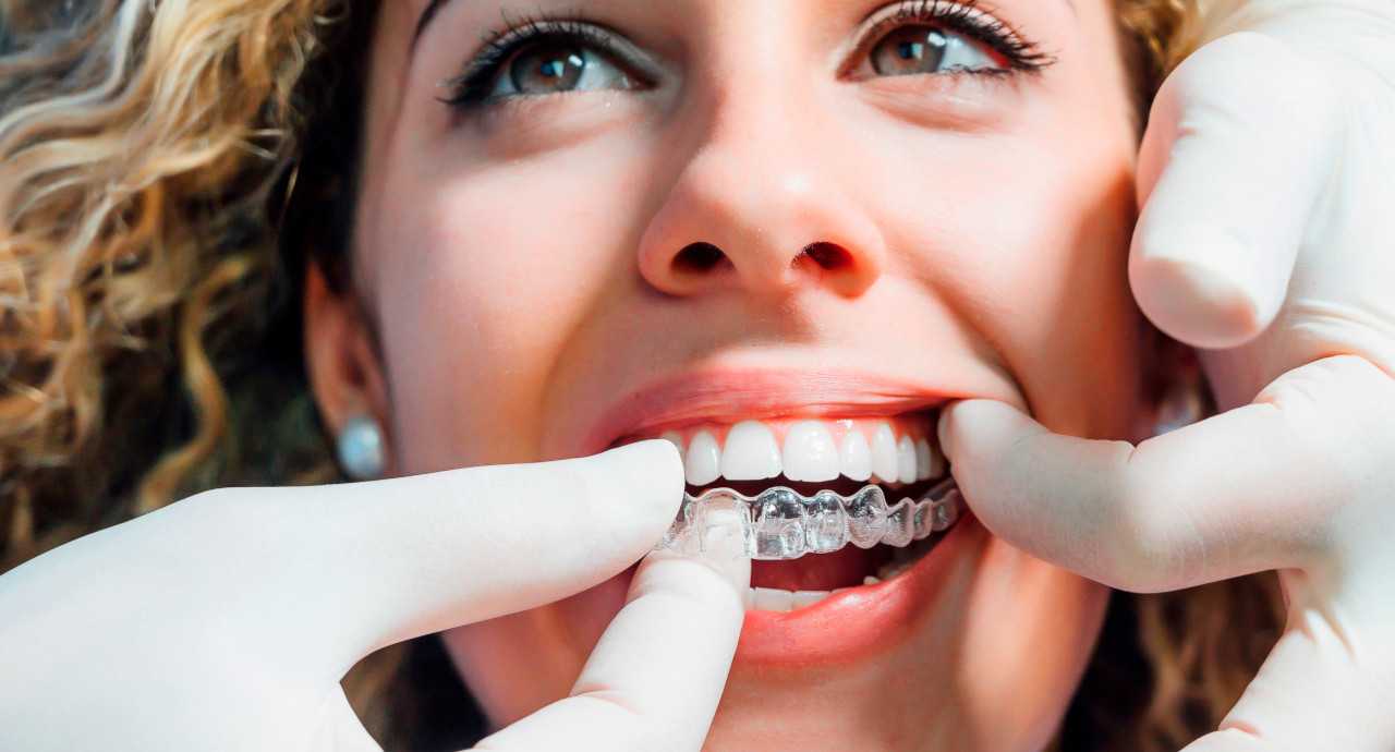 Chevauchement dentaire : traitement orthodontie invisible