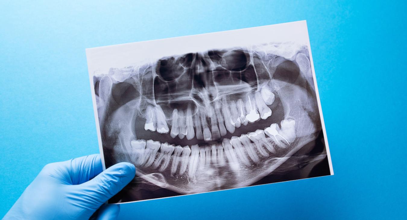Clichés radiographiques en orthodontie 