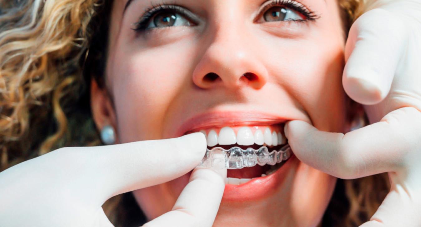 Chevauchement dentaire : traitement orthodontie invisible à Paris